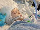 Out of surgery! Twin boys conjoined at the head are finally separate