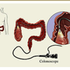 Colonoscopy 843-853-7730 Colon Surgeons Anal Rectal Distress Gastrointestinal Mount Pleasant