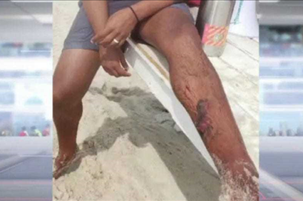 Georgia surf instructor attacked by shark during lesson returns to beach